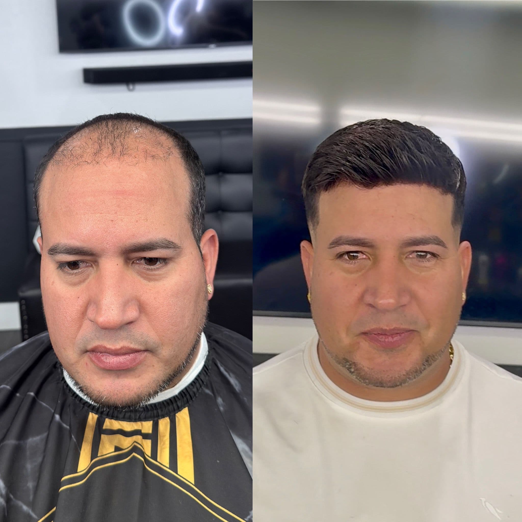Resultado de prótesis capilar — Adriano
